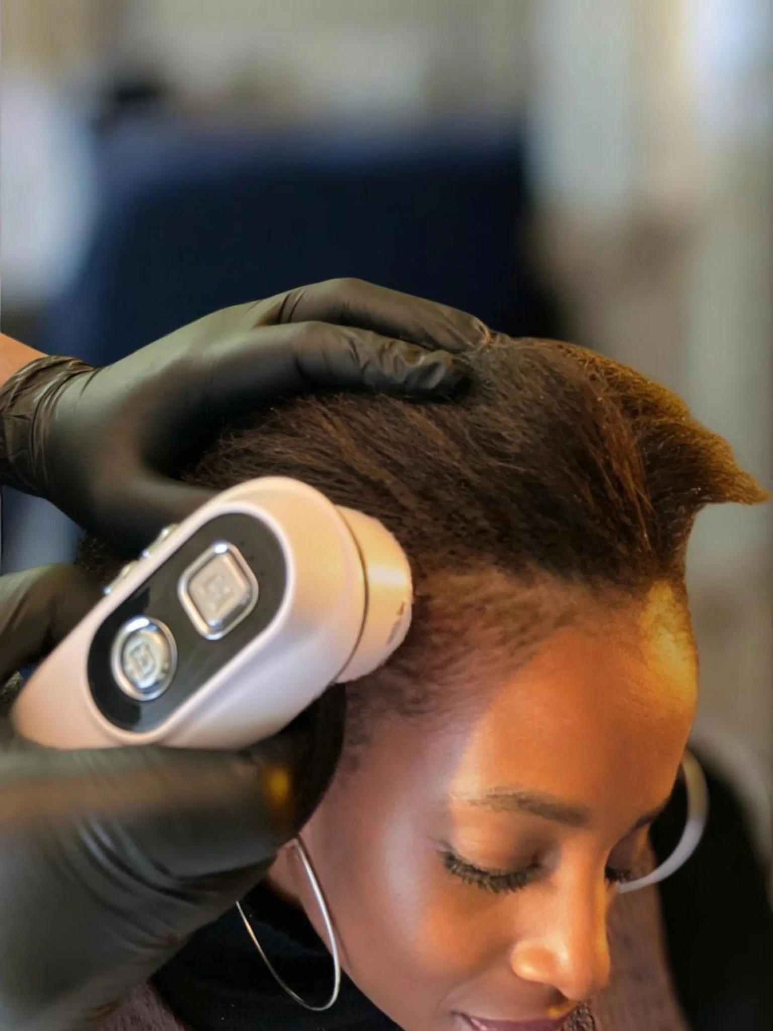 Before and after hair restoration treatment showing improved density