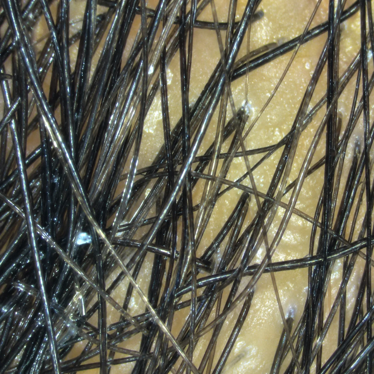 Patient receiving high frequency therapy for scalp health